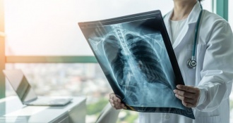 X quang COPD hỗ trợ chẩn đoán bệnh nhanh chóng, hiệu quả